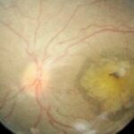 Clinical eye photograph illustrating Joubert Syndrome Ocular Motor Apraxia