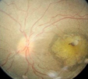 Joubert Syndrome: Reading Ocular Motor Apraxia as a Cerebellar Sign