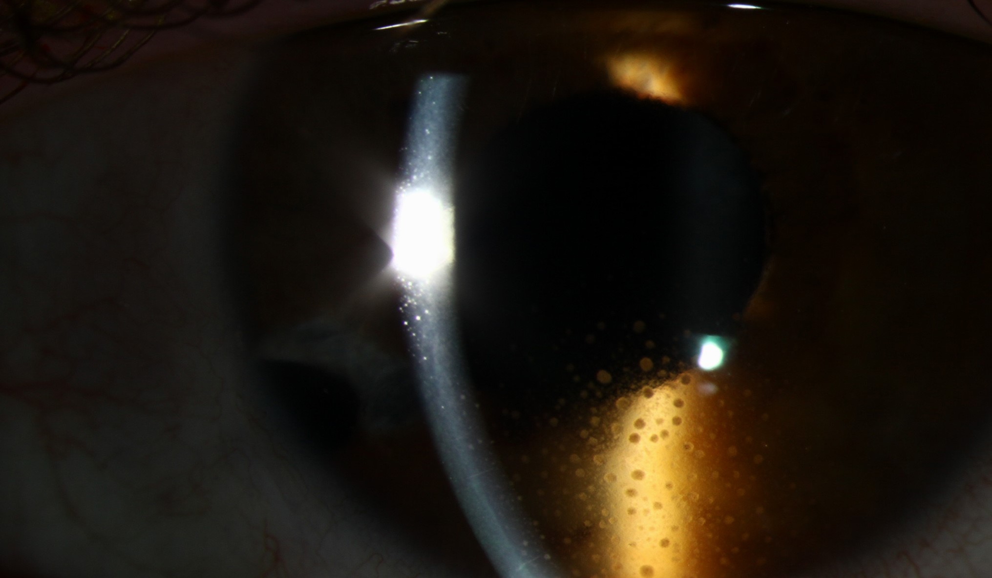 Clinical eye photograph illustrating Keratic Precipitate Patterns Uveitis