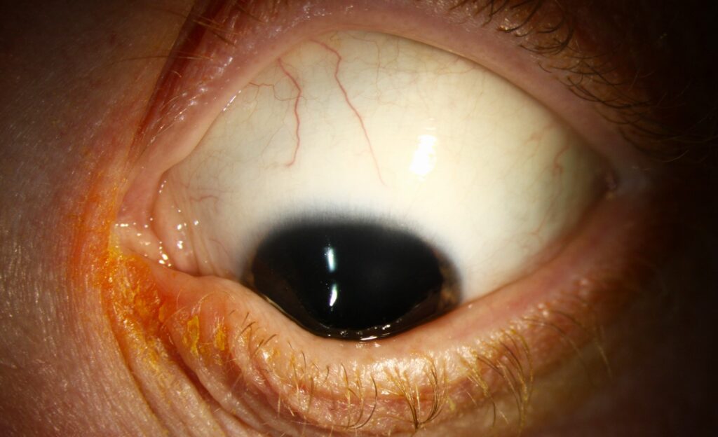 Keratoconus in Children: Detection and Treatment