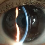 Clinical eye photograph illustrating Keratoconus Posticus