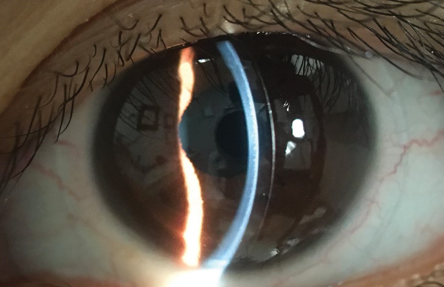 Keratoconus Posticus: Curvature Change on the Wrong Side of the Cornea