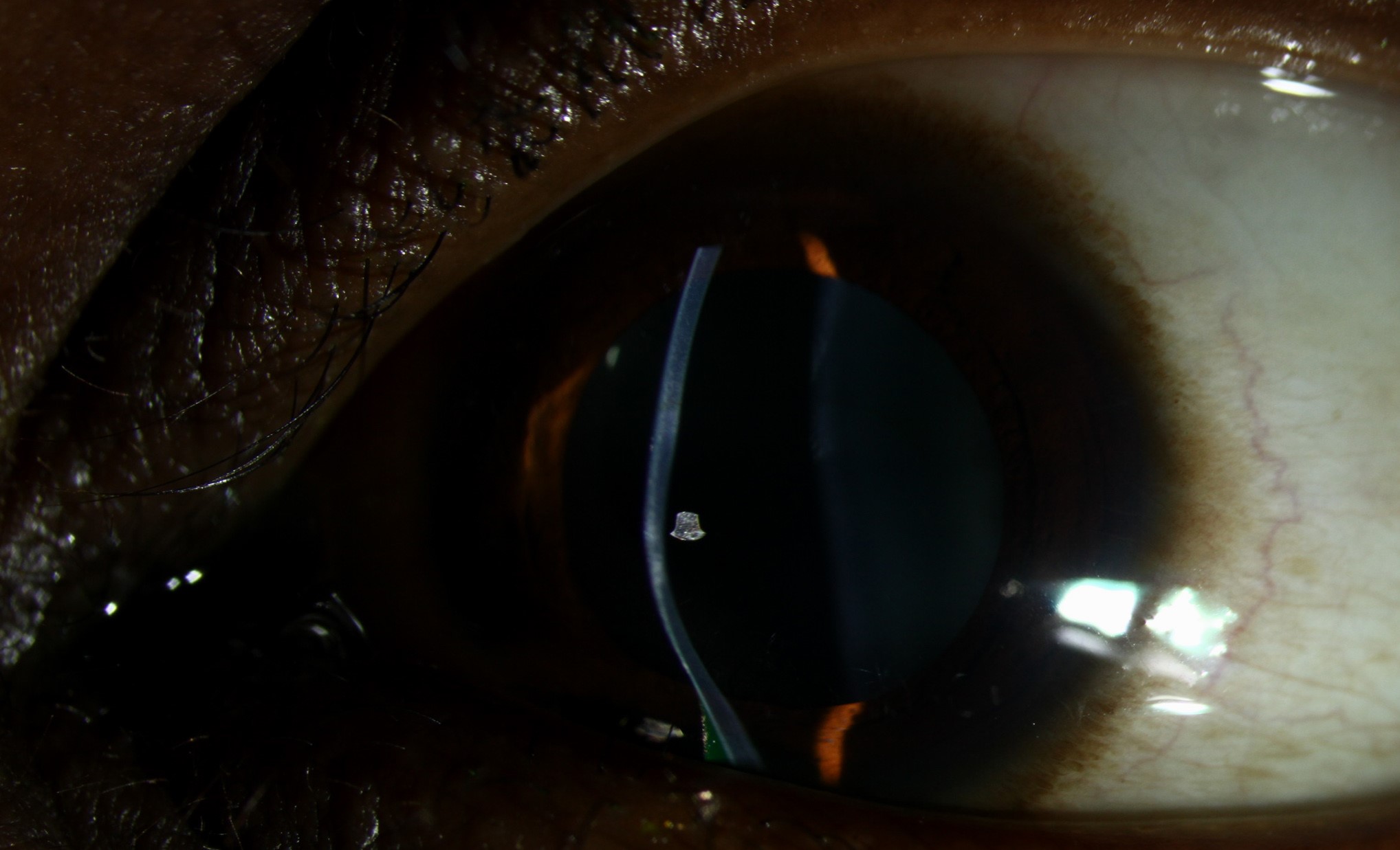Clinical eye photograph illustrating Keratoconus Posticus