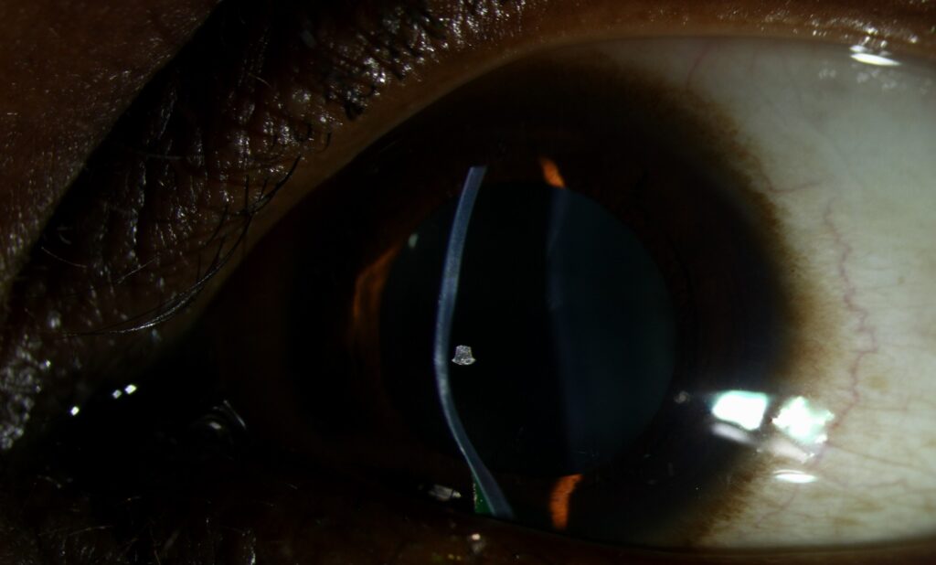 Clinical eye photograph illustrating Keratoconus Progression Crosslinking Criteria