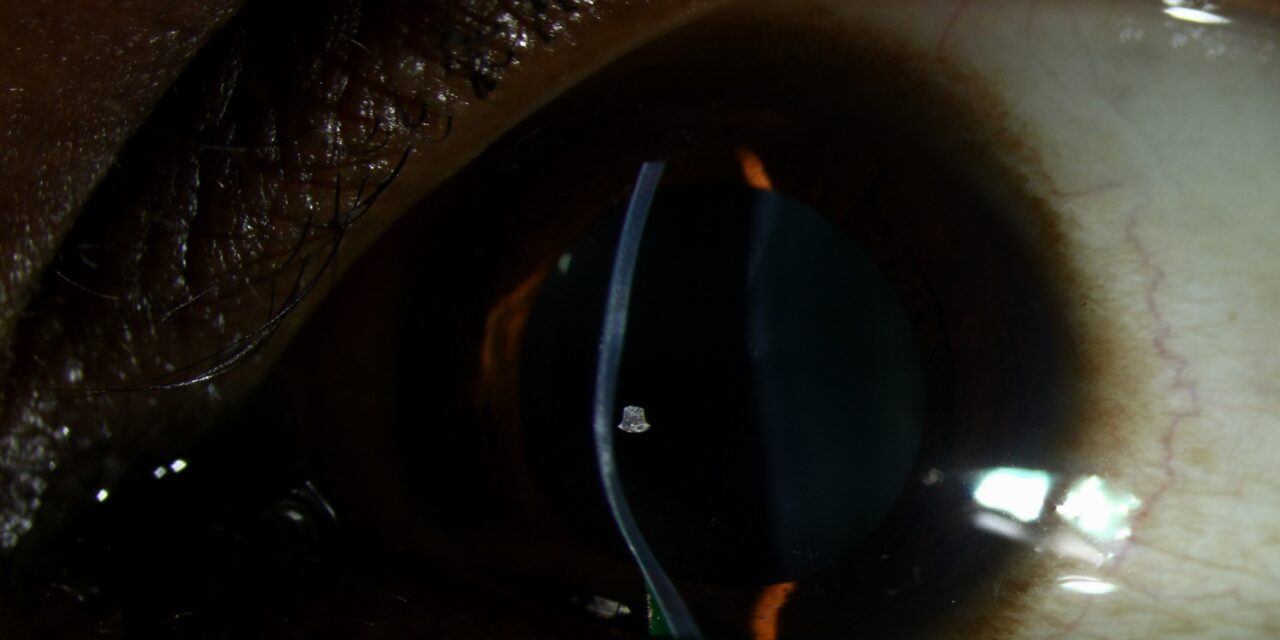 Keratoconus Progression: The Criteria That Decide Whether to Crosslink