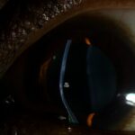 Clinical eye photograph illustrating Keratoconus Progression Crosslinking Criteria