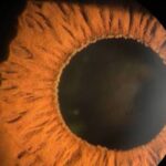 Clinical eye photograph illustrating Koeppe Busacca Nodules