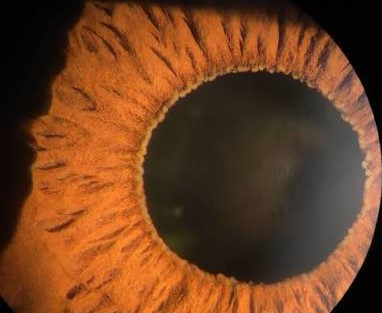 Koeppe and Busacca Nodules: The Iris Nodules of Granulomatous Uveitis