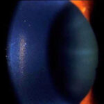 Clinical eye photograph illustrating Krukenberg Spindle