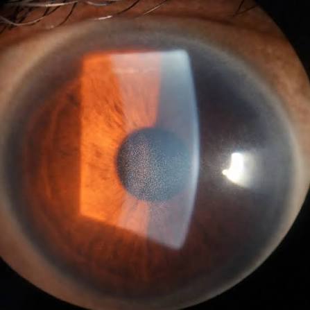 Clinical eye photograph illustrating Krukenberg Spindle