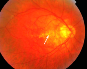 Clinical eye photograph illustrating Lacquer Cracks Pathologic Myopia