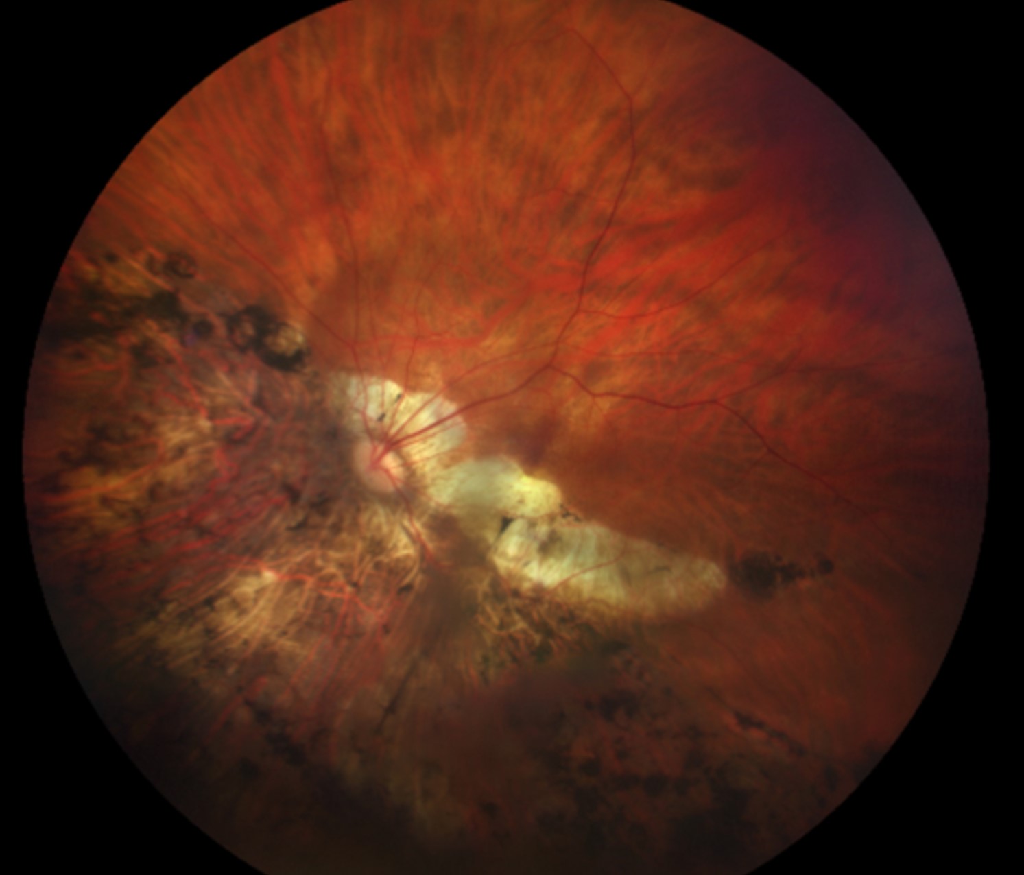 Clinical eye photograph illustrating Lacquer Cracks Pathologic Myopia