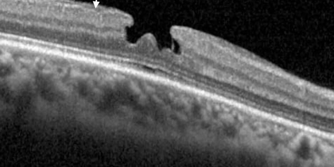 Lamellar Versus Full-Thickness Macular Hole: A Distinction That Changes the Whole Treatment Plan