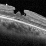 Clinical eye photograph illustrating Lamellar Macular Hole vs Full Thickness
