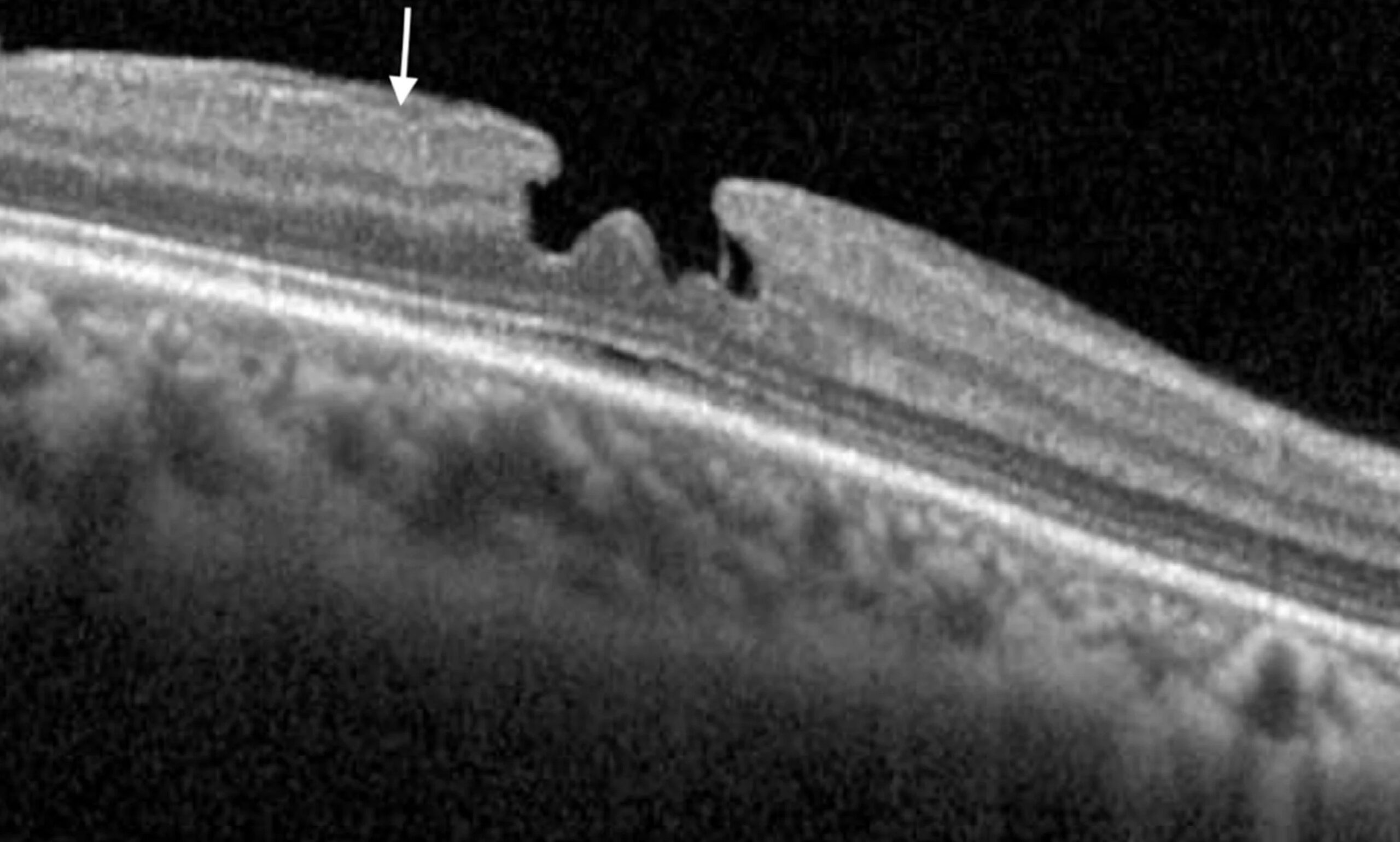 Clinical eye photograph illustrating Lamellar Macular Hole vs Full Thickness