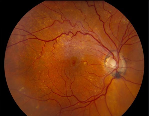 Clinical eye photograph illustrating Lamellar Macular Hole vs Full Thickness