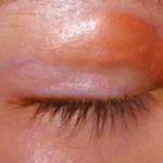 Clinical eye photograph illustrating Langerhans Cell Histiocytosis Orbital Involvement