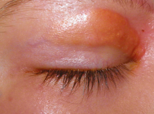 Langerhans Cell Histiocytosis of the Orbit: A Bone-Destroying Mimic of Infection
