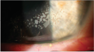 Clinical eye photograph illustrating Lasik Enhancement