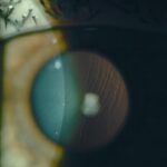 Clinical eye photograph illustrating Lasik Flap Complications