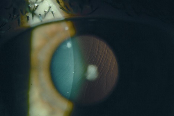 Clinical eye photograph illustrating Lasik Flap Complications