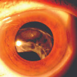 Clinical eye photograph illustrating Late in the Bag Iol Dislocation