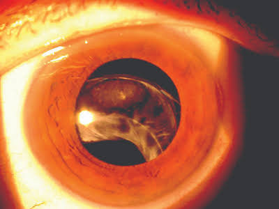 Late In-the-Bag Intraocular Lens Dislocation: Why a Lens Implant Can Fall Years After Surgery