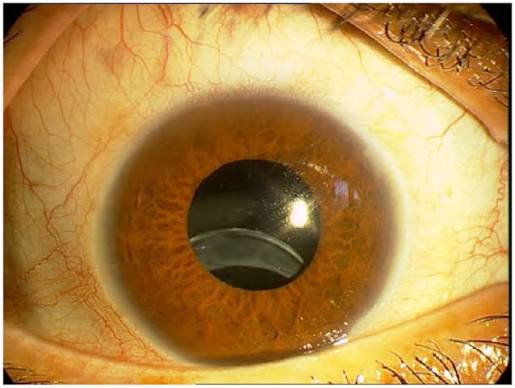 Clinical eye photograph illustrating Late in the Bag Iol Dislocation
