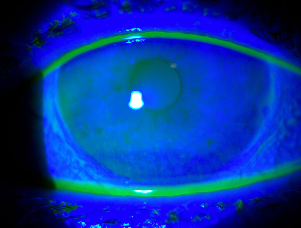 Clinical eye photograph illustrating Latest Treatments Dry Eye