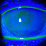 Clinical eye photograph illustrating Latest Treatments Dry Eye
