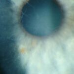 Clinical eye photograph illustrating Lattice Corneal Dystrophy Type1