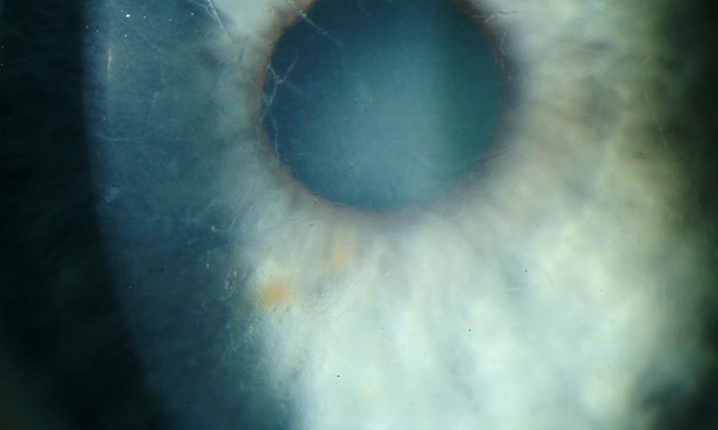 Clinical eye photograph illustrating Lattice Corneal Dystrophy Type1