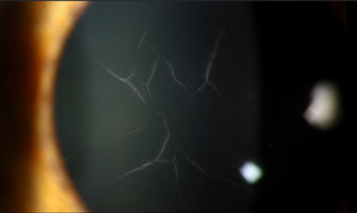 Clinical eye photograph illustrating Lattice Corneal Dystrophy Type1
