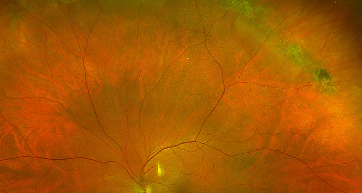 Lattice Degeneration With Holes: When Atrophic Retina Comes With Ready-Made Breaks