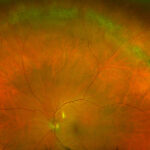 Clinical eye photograph illustrating Lattice Degeneration Retinal Holes