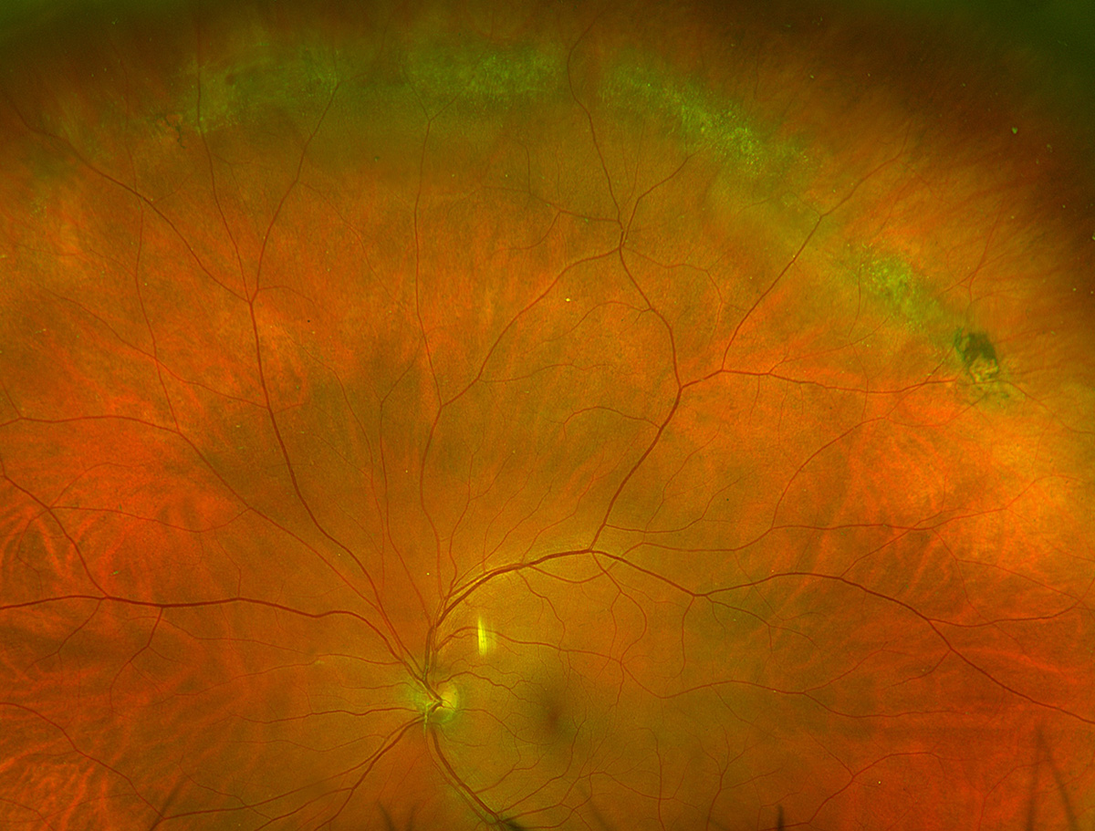 Clinical eye photograph illustrating Lattice Degeneration Retinal Holes