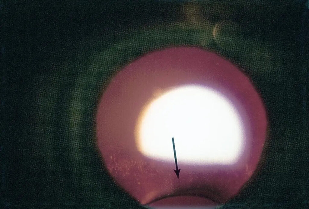 Clinical eye photograph illustrating Lens Coloboma