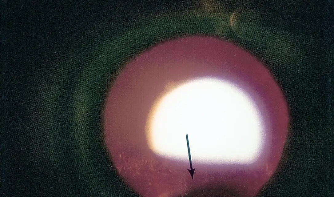 Lens Coloboma: A Notch in the Lens From the Same Fissure That Shapes the Iris