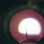 Clinical eye photograph illustrating Lens Coloboma