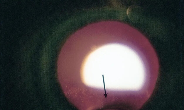 Lens Coloboma: A Notch in the Lens From the Same Fissure That Shapes the Iris