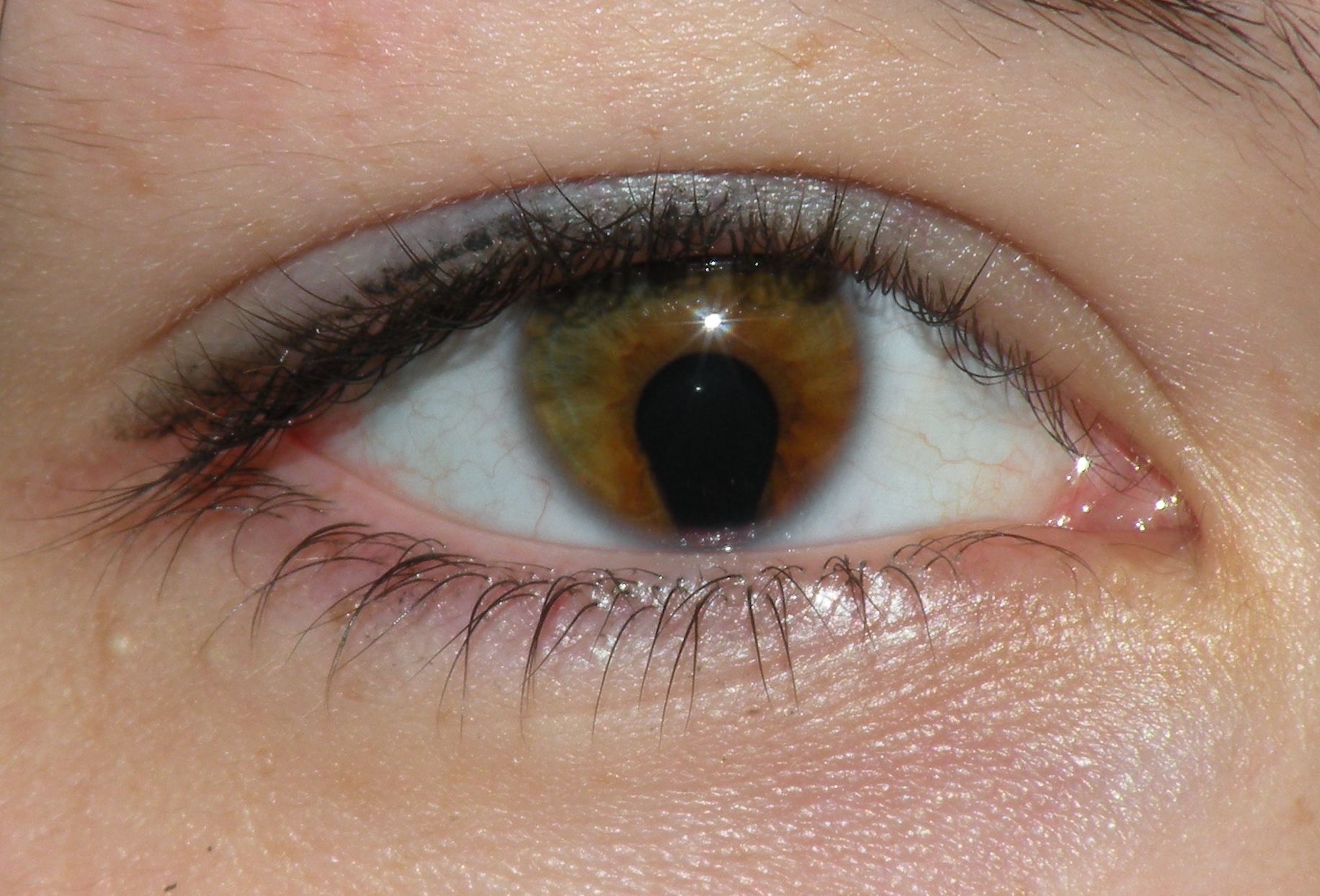 Clinical eye photograph illustrating Lens Coloboma