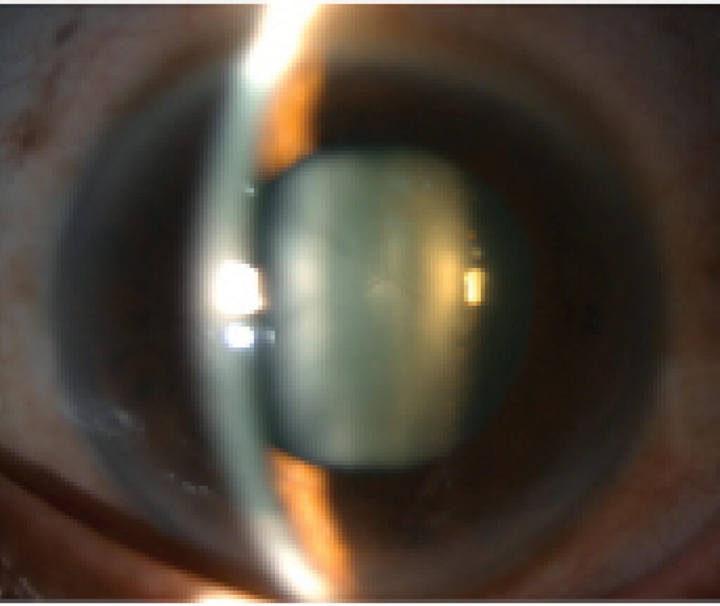 Clinical eye photograph illustrating Lens Subluxation Clinical Signs
