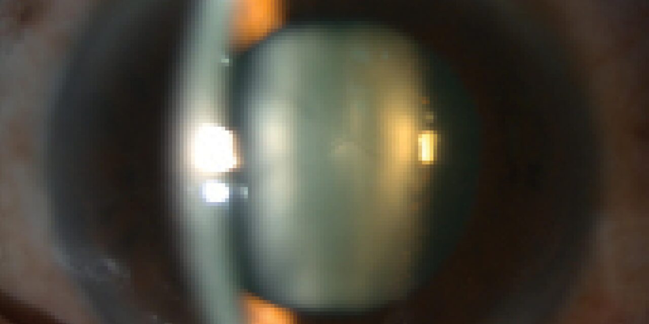 Lens Subluxation: The Clinical Signs That Reveal a Weakened Zonule