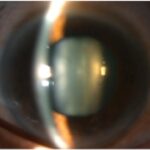 Clinical eye photograph illustrating Lens Subluxation Clinical Signs