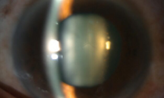 Lens Subluxation: The Clinical Signs That Reveal a Weakened Zonule