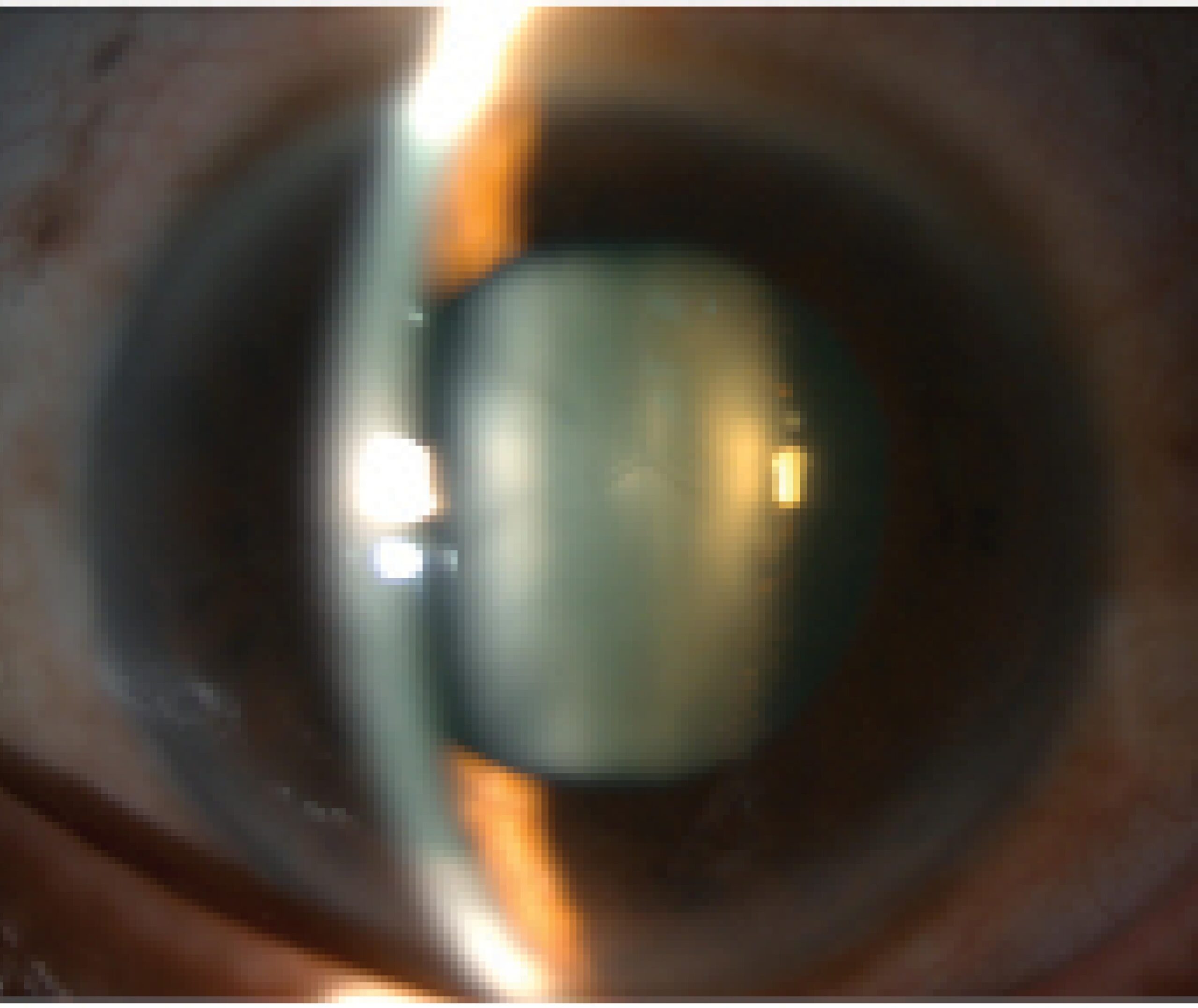 Clinical eye photograph illustrating Lens Subluxation Clinical Signs