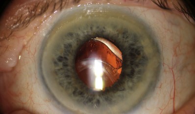 Clinical eye photograph illustrating Lens Subluxation Clinical Signs