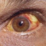 Clinical eye photograph illustrating Leptospirosis Uveitis