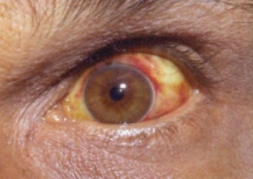 Leptospirosis Uveitis: The Delayed Intraocular Inflammation After Weil Disease