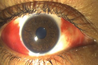 Clinical eye photograph illustrating Leptospirosis Uveitis